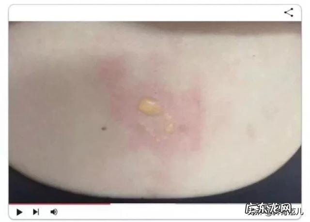 艾灸后为什么会起水泡？