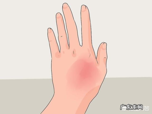 艾灸后为什么会起水泡?