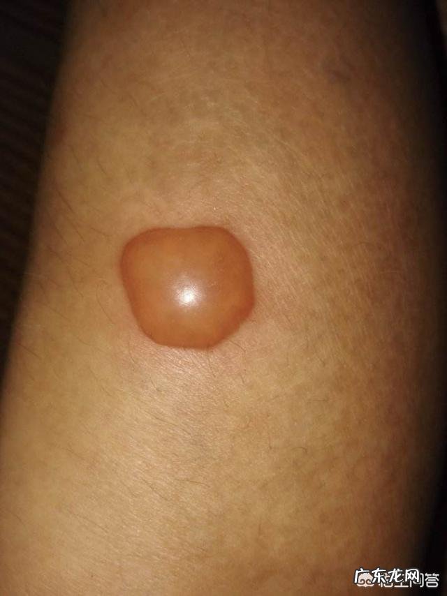 艾灸后为什么会起水泡？