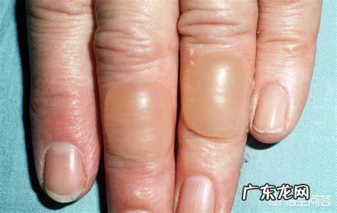 艾灸后为什么会起水泡?