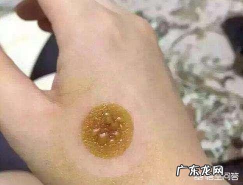 艾灸后为什么会起水泡?