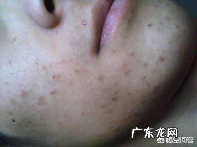 男生青春痘怎么快速消除?