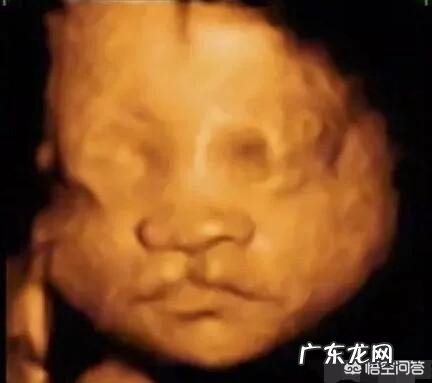 腹中胎儿唇腭裂是怎样引起的?胎儿基因排列正常,应该如何预防唇腭裂?
