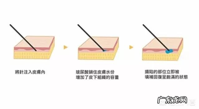 玻尿酸有什么用处?