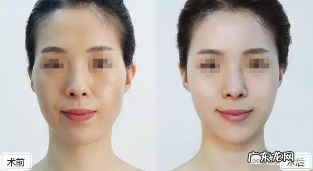 玻尿酸有什么用处?