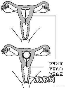 剖腹产后要不要上环,上环有什么坏处?