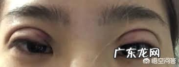 为什么双眼皮修复要等到半年以上？
