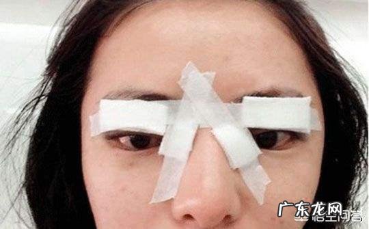 为什么双眼皮修复要等到半年以上？