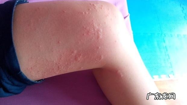 像荨麻疹这种皮肤病,会遗传下一代吗?