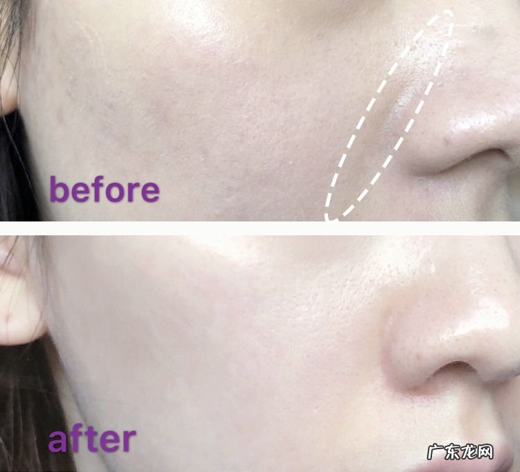 如何去除抬头纹 怎样去除抬头纹和法令纹