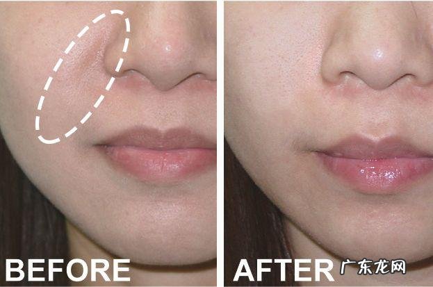 如何去除抬头纹 怎样去除抬头纹和法令纹