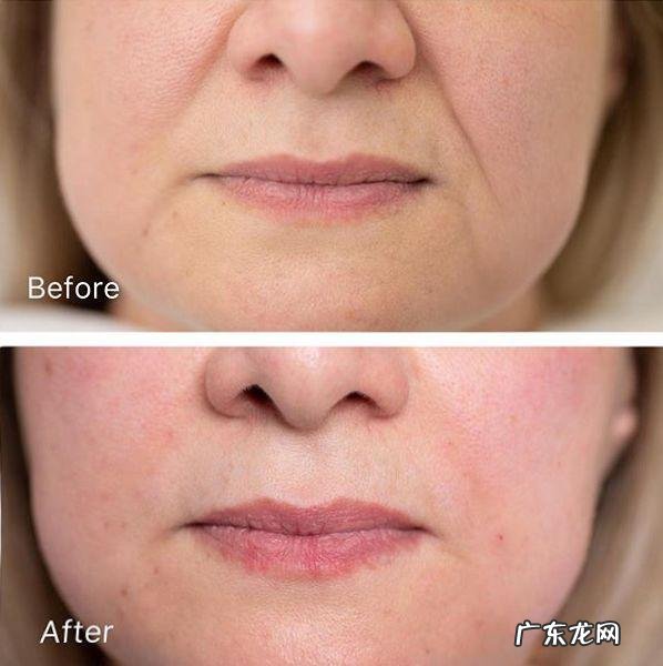 如何去除抬头纹 怎样去除抬头纹和法令纹