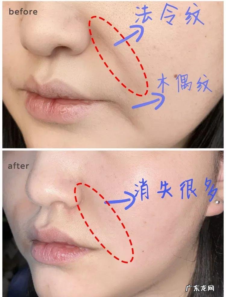 如何去除抬头纹 怎样去除抬头纹和法令纹