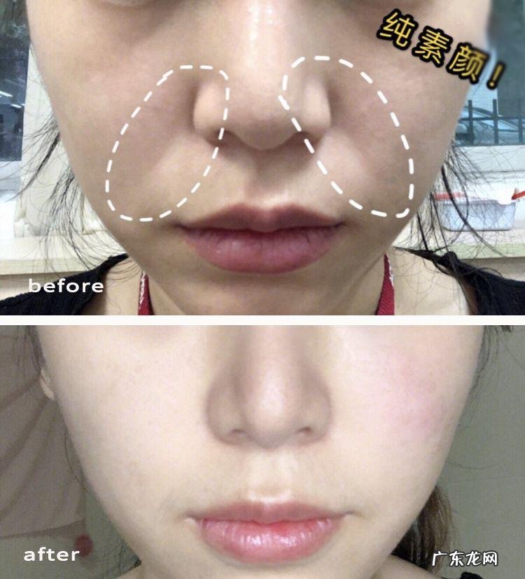 如何去除抬头纹 怎样去除抬头纹和法令纹