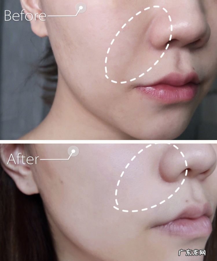 如何去除抬头纹 怎样去除抬头纹和法令纹