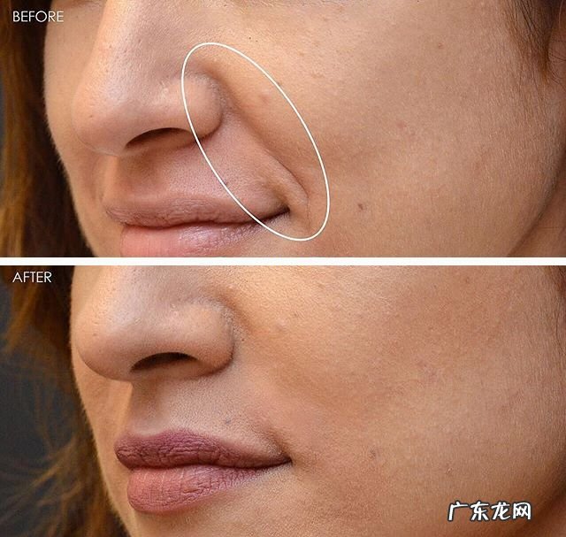 如何去除抬头纹 怎样去除抬头纹和法令纹