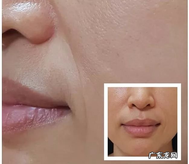 如何去除抬头纹 怎样去除抬头纹和法令纹