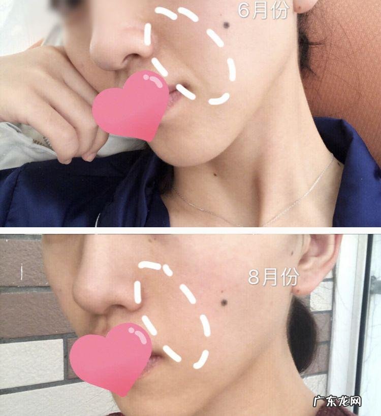 如何去除抬头纹 怎样去除抬头纹和法令纹