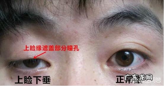 如何去除抬头纹?