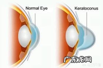 做近视激光手术有什么副作用吗?