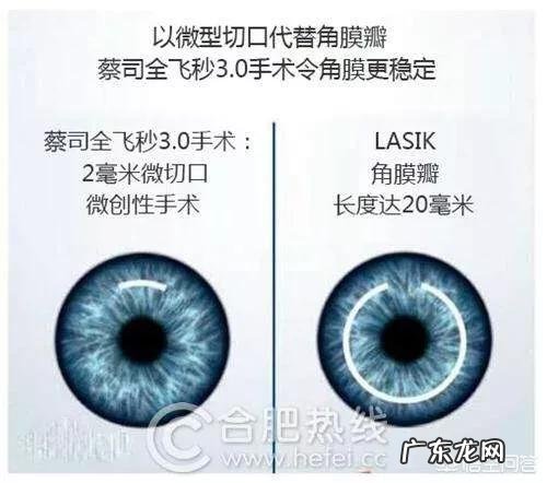 做近视激光手术有什么副作用吗?