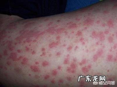 过敏性紫癜患者如何注意日常生活饮食?