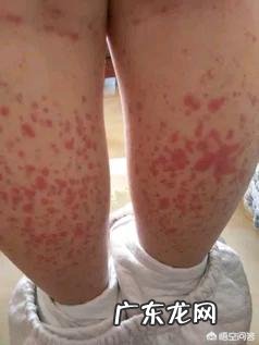 过敏性紫癜患者如何注意日常生活饮食?