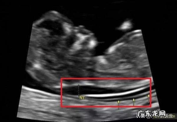 孕妇做NT值为2.6,属于高风险吗?