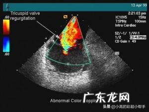 B超和彩超有什么区别?
