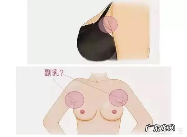 怎样才能把副乳去掉？