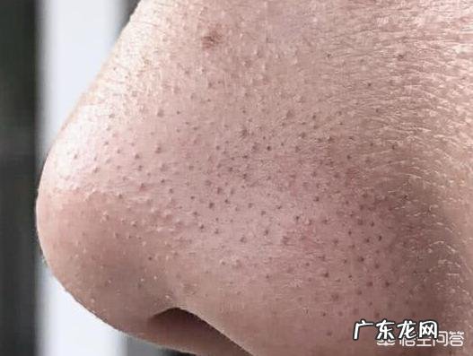 鼻子上黑头超级多该怎么办呢?