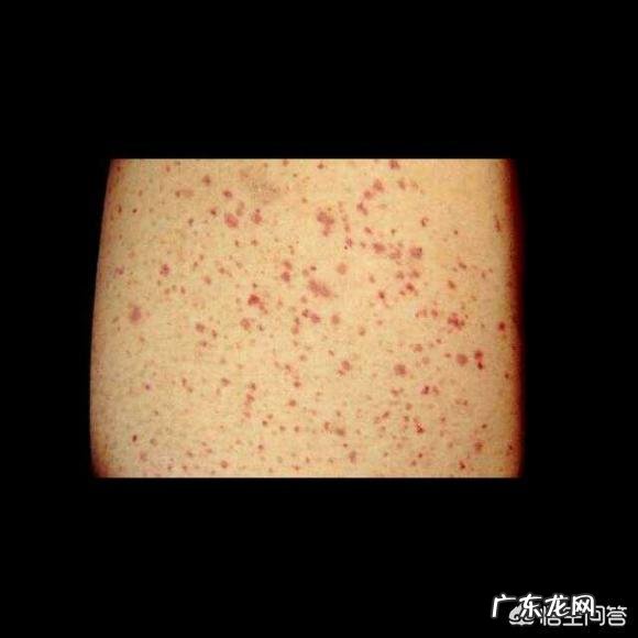 小儿过敏性紫癜如何治疗和预防？