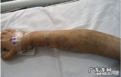 小儿过敏性紫癜如何治疗和预防？