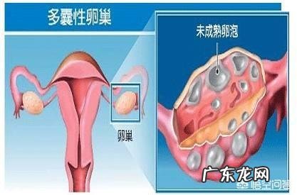多囊卵巢女性可以自然怀孕吗?为什么?