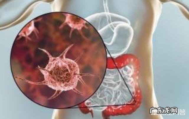 中期直肠癌没有转移能治愈吗?需要注意些什么?