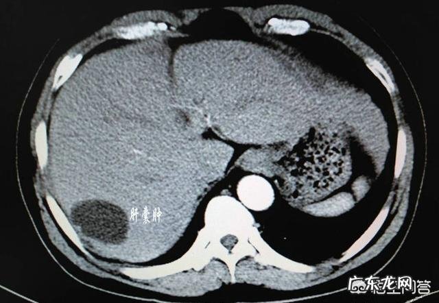 肝囊肿是怎么回事?