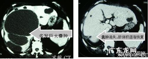 肝囊肿是怎么回事?