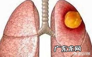 肝囊肿是怎么回事?