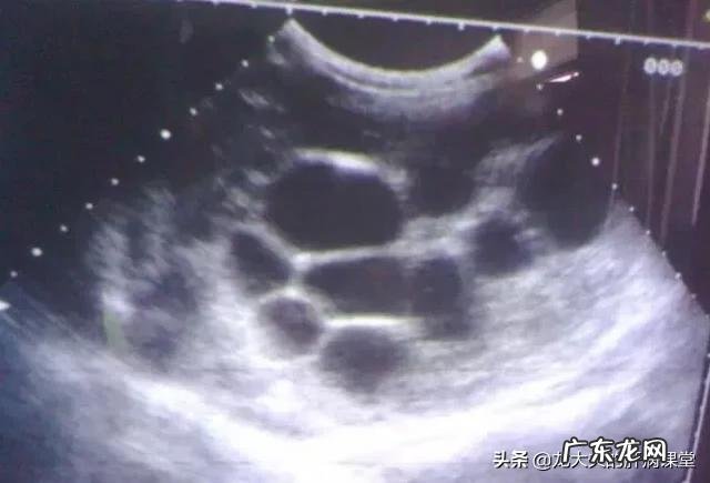 肝囊肿是怎么回事?