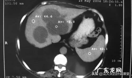 肝囊肿是怎么回事?