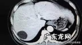 肝囊肿是怎么回事?