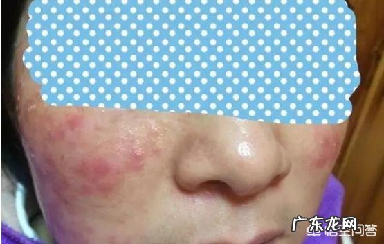 水光针对皮肤有哪些副作用？