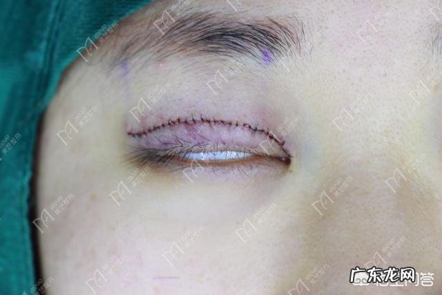 双眼皮拆线会疼吗 ？