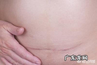 剖腹产伤口护理注意事项有哪些?