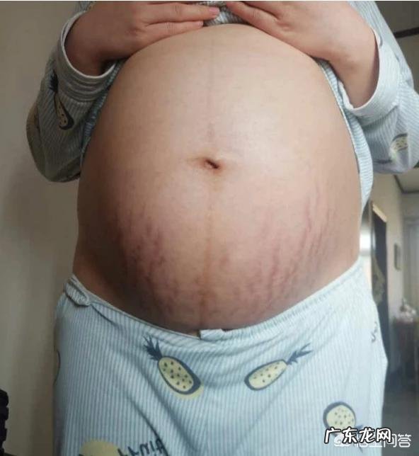 剖腹产伤口护理注意事项有哪些?