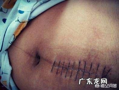 剖腹产伤口护理注意事项有哪些?