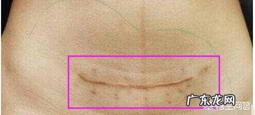 剖腹产伤口护理注意事项有哪些?