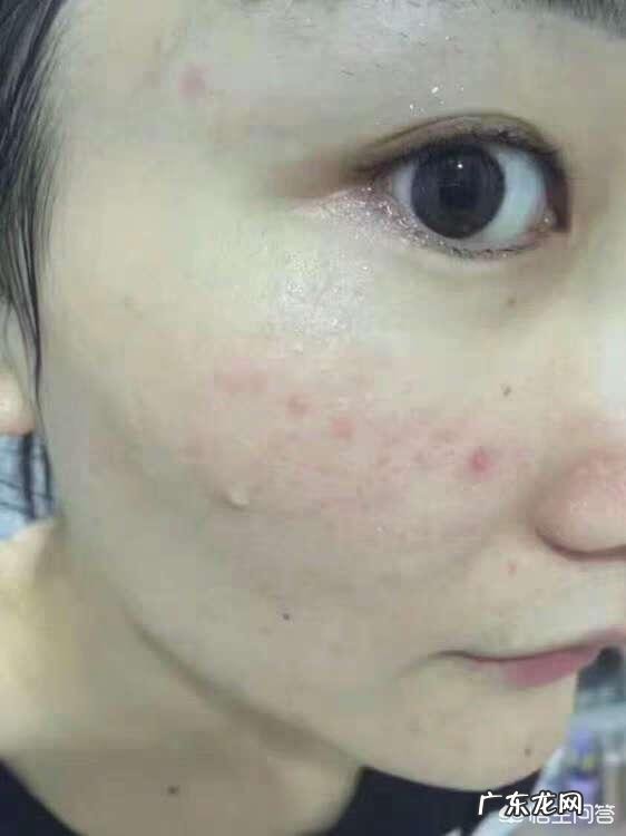 用什么可以祛痘？