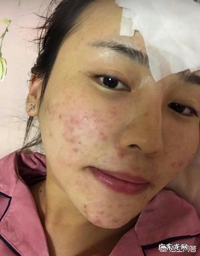 用什么可以祛痘?