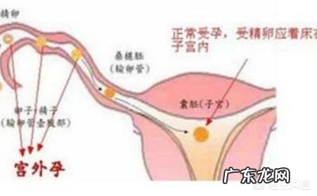 宫外孕能变成宫内孕吗?